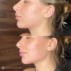 Cheek And Jaw Fillers, Jaw Line Botox Before And After, Botox For Slimmer Face, Jaw And Chin Filler Before And After, Before And After Jaw Filler, Jaw Contouring Filler, Jawline Contouring Filler, Facial Symmetry Filler, Jaw And Chin Filler