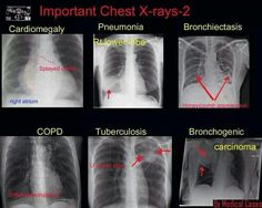 chest x - rays are shown with different types of thoraches and their corresponding conditions