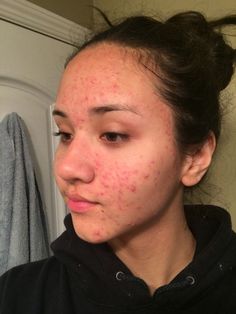 Romanticizing Acne, Acne Acceptance, Acne Beauty, Skincare Supplements