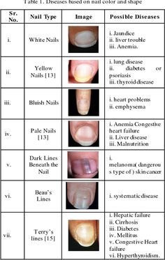 Fingernail Health, Nail Disorders, Healthy Nail Polish, Nail Conditions, Nail Problems, Tongue Health, Nail Care Tips, Medical Knowledge, Nail Fungus