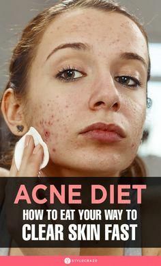 The foods you eat affect your skin directly. If you are unhappy with your skin, use this anti-acne diet to restore your skin Clear Skin Diet, Clear Skin Fast, Skin Diet