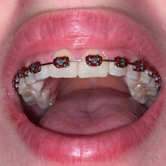 Red Braces Teeth, Red Braces Aesthetic, Red Braces Color, Dark Red Braces, Braces Aesthetic Colors, Maroon Braces, Braces Accessories, Power Chain Braces, Braces Colours