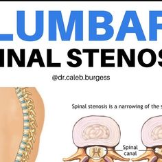 an image of the lumbar sinal stenosis