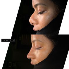 Case of the day 👃 We tried to do the best 👌 Came from USA 🇺🇸 Rib cartilage used 👍 #nosework #nasenkorrektur #ethnicrhinoplasty… | Instagram Prol Dress, Finesse Rhinoplasty, Nose Job Inspiration Natural, Roxanne Core, Bulbous Nose Rhinoplasty Before After, Natural Nose Job, Nose Inspiration, Rhinoplasty Recovery