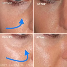 Trough Filler Before After, How To Get Rid Of Tear Troughs, Eye Trough Filler, Undereye Fillers Before And After, Tear Through Eye Filler, Tear Through Filler Before And After, Tear Trough Remedy Natural, Prp Undereye Before And After, Eye Trough Filler Before And After