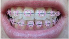 Clear Braces Ceramics, Girly Words, Pink Braces, Jewelry Teeth, Braces Colors Ideas, Teeth Gems, Delicious Healthy Food