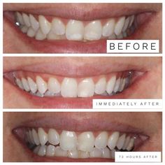 The 14 Best Teeth Whitening Products of 2022 How To Get Rid Of White Spots On Teeth, Braces Stains, Teeth After Braces, White Spots On Teeth, Braces Off, Health Aesthetic, Veneers Teeth, Discolored Teeth