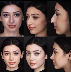 Round Face Nose Job, Nose Job Results, Button Nose Job, Nose Job Inspiration, Nose Job Inspo, Natural Nose Job, Bad Nose Jobs, Nose Aesthetic