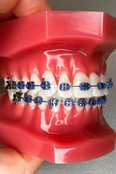 The Best Colors For Braces, Navy Blue Power Chain Braces, Braces Colors Navy Blue, Braces Royal Blue, Aesthetic Braces Color Combos, Royal Blue Braces Teeth, Blue Braces Colors, Baby Blue Braces, Best Braces Colors Ideas