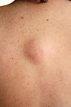 If you see cysts, milia, ingrown hairs, and other bumps on your face, you should not pop them. Dermatologists share how to treat these pimples under your skin. Blind Pimple, Pimples Under The Skin, Skin Bumps, Skin Growths, Healthy Fruit, Ingrown Hairs