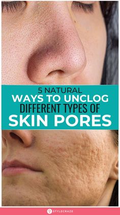 Natural Hacks, Big Pores, Types Of Skin, How To Get Rid Of Pimples, Reduce Pores, Get Rid Of Blackheads, Large Pores, Skin Pores, Clean Pores