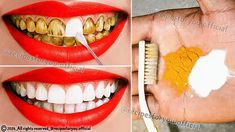 Do you want whiter teeth? Use these little secrets Yellow Teeth Remedy, Teeth Aesthetic