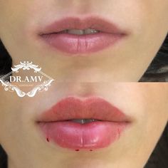 Lips Fillers, Natural Lip Plumper, Lips Shape, Rhinoplasty Nose Jobs, Face Fillers, Botox Lips