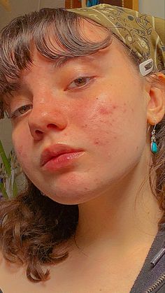 Strawberry Freckles, Acne Women, Fairy Energy