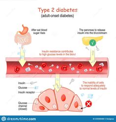 the stages of type 2 diabets and how they are used to treat them