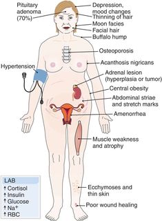 Pituitary Gland Tumor, Cushings Disease, Neurological Assessment, Acanthosis Nigricans, Adrenal Cortex, Cushings Syndrome, Medical Dictionary, High Cortisol, Endocrine Disorders