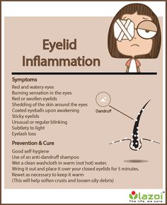 You need to know about Eyelid inflammation symptoms and preventon. Inflammation Symptoms, Eye Swelling, Swollen Eyelid, Eye Problems, Strep Throat, Watery Eyes, Anti Dandruff Shampoo, Medical Anatomy