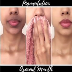 Causes And Remedies For Skin Pigmentation Around The Mouth Hyperpigmentation Around Mouth, Lip Hyperpigmentation, Dark Skin Around Mouth, Pigmentation Remedy, Remedies For Dark Lips, Get Rid Of Hyperpigmentation, Removing Hyperpigmentation, Remedies For Skin, Treating Hyperpigmentation