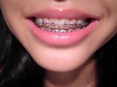 What are Lingual Braces Dental Braces Colors, Pink Braces, Lingual Braces, Braces Bands, Cute Braces Colors, Kids Braces, Braces Tips, Getting Braces, Braces Girls