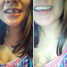 Fix Teeth, Tooth Replacement, Home Health Remedies, Perfect Smile