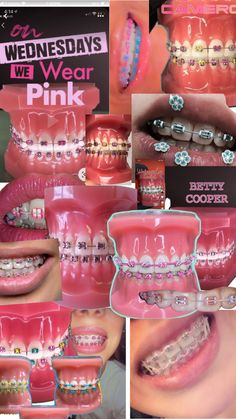 Summer vibes ☀️🦋🩷 Pink Braces, Braces And Glasses, Cute Braces Colors, Pretty Teeth, Creative Snaps For Snapchat, Grillz Teeth, Braces Tips