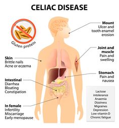 Graves Disease, Thyroid Health, Stomach Pain, Diet Vegetarian, Nclex, Chronic Fatigue, The Human Body, Autoimmune Disease, Dental Health