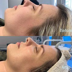 Microdermabrasion is a true skin perfecting treatment, but it has its limits. Let's find out does microdermabrasion work for different conditions. Microdermabrasion Before And After, Dermabrasion Before And After, Microdermabrasion Benefits, Massage Envy, Facial Tips, The Dating Divas, Get In Shape, Things To Know, Massage