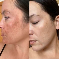 Real Life-Changing Results With Musely FaceRx | #MuselyWorks Pigmentation On Face, Skin Balm, Skin Care Treatments, Skin Concern, Uneven Skin Tone, Skin Cream, Oils For Skin