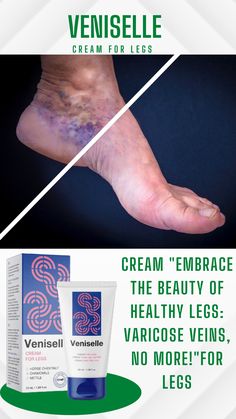 Varicose Vein Ulcers, Varicose Veins Exercises, Vericous Veins, Circulation Remedies, Varicose Veins Causes, Varicose Vein Cream, Healthy Legs, Health Facts Fitness