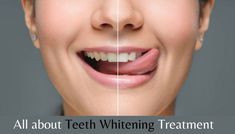 teeth whitening treatment Teeth Whitening Procedure, Brighten Teeth, Discolored Teeth, Teeth Whitening Toothpaste, Teeth Bleaching, Teeth Whitening Strips