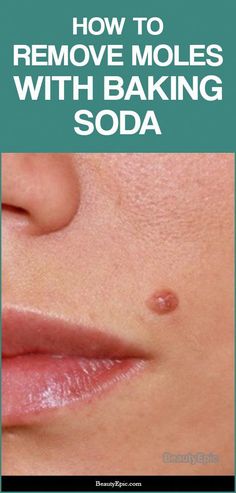 How To Remove Moles, Skin Tags On Face, Moles On Face, Dark Mole, Remove Moles, Red Moles, Skin Moles, Skin Growths, Mole Removal