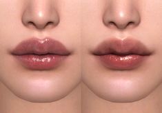 three different angles of lips with the same amount of lip fillers on their cheeks