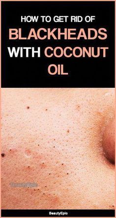 For Blackheads, To Remove Blackheads, Rid Of Blackheads, Black Heads, Coconut Oil Uses, Remove Blackheads, Natural Sleep Remedies