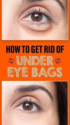 Eye Bag Remedies, Puffy Eyes Remedy, Droopy Eyelids, Remove Dark Circles, Under Eyes, Dark Circles Under Eyes, Sciatic Nerve, Eye Wrinkle, Under Eye Bags