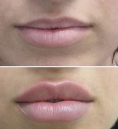 Lip Flip, Pdo Threads, Face Treatments