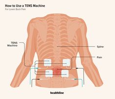 Tens Unit Placement Charts, Tens Electrode Placement, Back Spasm Relief, Pediatric Physical Therapy Activities, Back Spasm, Tens And Units, Lumbar Pain