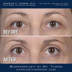 Before and after blepharoplasty by Dr. Thorne  https://charlesthornemd.com/face-surgery/blepharoplasty-eyelid-surgery.html - - #cosmeticsurgery #plasticsurgery #facelift #beforeandafter #plasticsurgeon #beauty #nyc #bestplasticsurgeon #newyork #facelift #surgery #beauty #chinimplant #transformation #beforeandafter #bestplasticsurgeon #blepharoplasty #doctor #necklift #boardcertifiedplasticsurgeon #eyes #eyelidsurgery Chin Implant