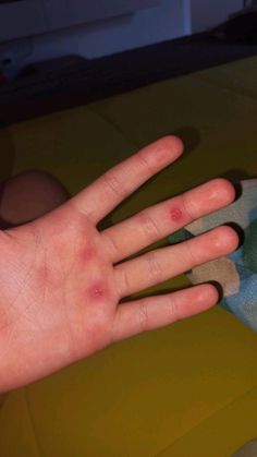 a person's hand with red spots on it and a teddy bear in the background