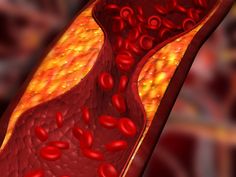 5 Drinks that Help Unclog Arteries Fast! - BlackDoctor.org - Where Wellness & Culture Connect Artery Cleanse, Pure Cranberry Juice, Lowering Ldl, Lower Ldl Cholesterol, Coronary Arteries