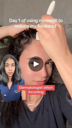 7.7M views · 15K reactions | 3 minoxidil hacks for MORE hair growth from a dermatologist.   As a dermatologist with hair loss myself, I know how frustrating it can be when you start to notice balding or hair thinning. Here are 3 minoxidil hacks that will help you get the most out of your hair growth routine.  1. Use a dermaroller a few times per week before you apply minoxidil. Dermarollers create these micro punctures in the scalp which allow minoxidil to absorb better. Make sure to sanitize your dermaroller with 70% Isopropryl alcohol before and after use, and look for a dermaroller with 0.25 to 0.5 mm needles.  2. Use “Men’s” Rogaine 5% foam, which is more powerful and less irritating than the 2% liquid. Apply it nightly and wash your face and do your skincare routine afterwards to avoi Hair Growth Routine, Increase Hair Thickness, Wow Hair Products, Hair Thinning, Derma Roller, I Feel Pretty, Wash Your Face, Beauty Care, Skincare Routine