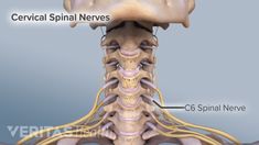 C5 C6 Pinched Nerve, C5 C6 Neck Pain, Narrowing Of The Spine, Spinal Degeneration, Cervical Disc, Nerve Anatomy, Vertebral Artery, Cervical Spondylosis, Spinal Fusion