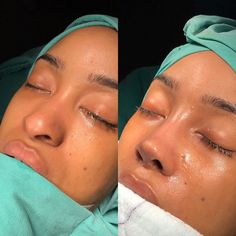 Nose Job For Wide Nose, Dream Nose Job, Nose Job Droopy Tip, Droopy Tip Nose Rhinoplasty, Nose Job Thick Skin, Black Button Nose, Nose Job Wide Nose