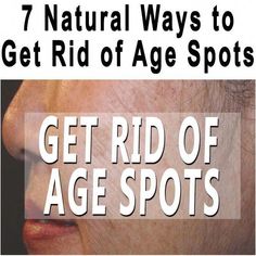 How To Get Rid Of Brown Spots, How To Get Rid Of Age Spots On Skin, Age Spots On Face How To Get Rid Of, How To Get Rid Of Age Spots On Hands, Remove Age Spots On Hands, Natural Age Spot Remover, Diy Age Spot Remover, Get Rid Of Age Spots On Face, How To Get Rid Of Age Spots