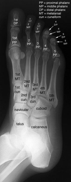 an x - ray shows the foot bones and their corresponding muscles, including the carpus