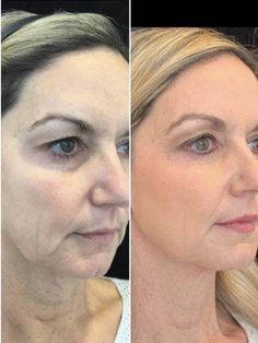 Sagging Skin Face, Sagging Skin Remedies, Skin Tightening Procedures, Natural Facial Mask, Laser Skin Tightening, Facial Procedure, Skin Tightening Treatments, Face Tightening, Skin Tightening Face