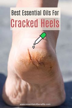 Seasickness Remedies, Essential Oils For Nails, Cracked Heels Remedy, Essential Oils Logo, Cracked Heel, Healing Tips