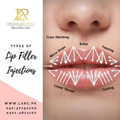 Dermal Fillers Lips, Pouting Lips, Cosmetic Fillers, Nurse Injector, Facial Anatomy, Skin Facts, Facial Fillers, Cosmetic Injectables, Skin Aesthetics