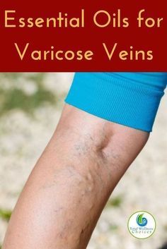 Essential Oils For Varicose Veins, Varicose Vein Remedy, Oil Remedies, Patchouli Essential Oil, Young Living Oils, Best Essential Oils, Essential Oil Uses, Natural Health Remedies