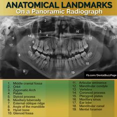 Dental Assistant X Ray Study, Dental Xrays Tips, Dental Assistant Radiology Study, Dental Morphology Anatomy, Panoramic Radiograph, Dental Occlusion Classification