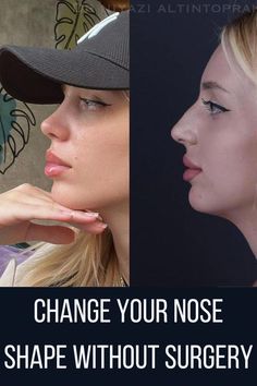 Rhinoplasty Inspiration, Nose Inspiration, Nose Operation, Nose Job Recovery, Nose Plastic Surgery, Nose Jobs, Beautiful Nose, Rhinoplasty Nose Jobs, Face Fillers